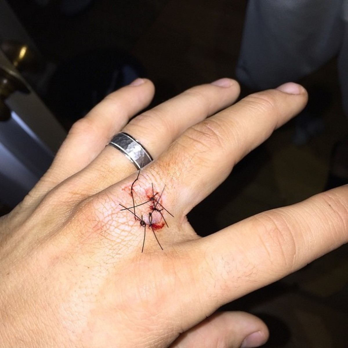 scooter_gennett_injury.jpg